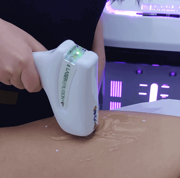 Epilazione-laser-campobasso