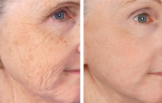 peeling-chimico_viso